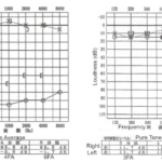 How to read an Audiogram (1)の詳細へ